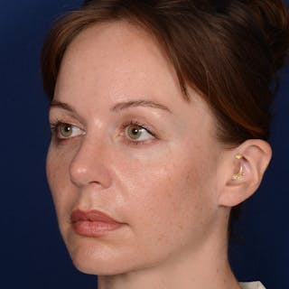 Corrective / Revision Rhinoplasty Before & After Gallery - Patient 317071 - Image 4