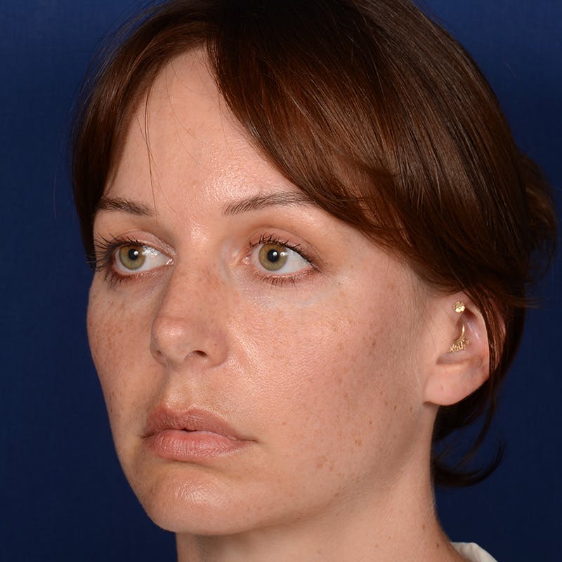 Corrective / Revision Rhinoplasty Before & After Gallery - Patient 317071 - Image 4