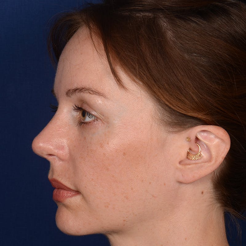 Corrective / Revision Rhinoplasty Before & After Gallery - Patient 317071 - Image 5