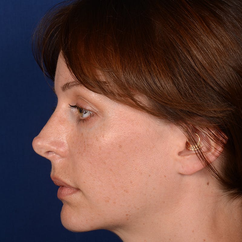 Corrective / Revision Rhinoplasty Before & After Gallery - Patient 317071 - Image 6