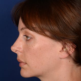Corrective / Revision Rhinoplasty Before & After Gallery - Patient 317071 - Image 6