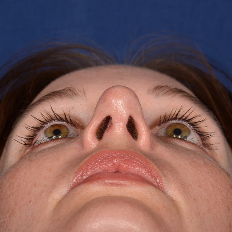 Corrective / Revision Rhinoplasty Before & After Gallery - Patient 317071 - Image 8