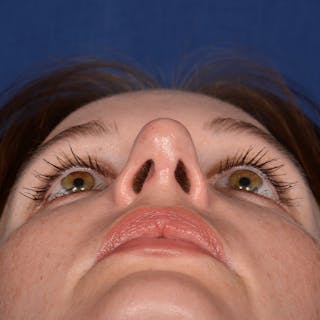 Corrective / Revision Rhinoplasty Before & After Gallery - Patient 317071 - Image 8