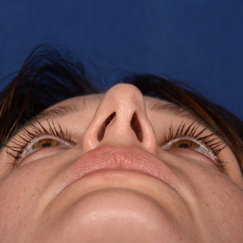 Corrective / Revision Rhinoplasty Before & After Gallery - Patient 317071 - Image 7