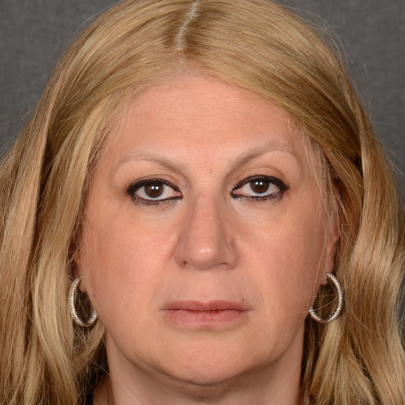 Corrective / Revision Rhinoplasty Before & After Gallery - Patient 317756 - Image 1