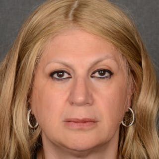 Corrective / Revision Rhinoplasty Before & After Gallery - Patient 317756 - Image 2