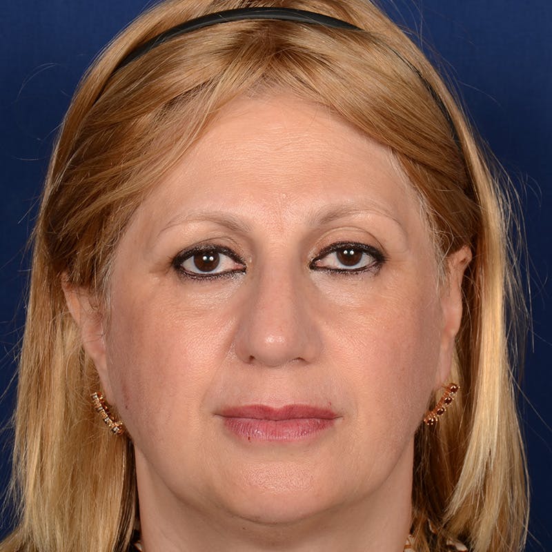 Corrective / Revision Rhinoplasty Before & After Gallery - Patient 317756 - Image 2