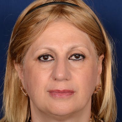 Corrective / Revision Rhinoplasty Before & After Gallery - Patient 317756 - Image 2