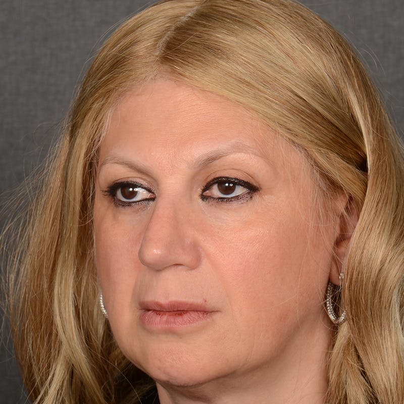 Corrective / Revision Rhinoplasty Before & After Gallery - Patient 317756 - Image 3