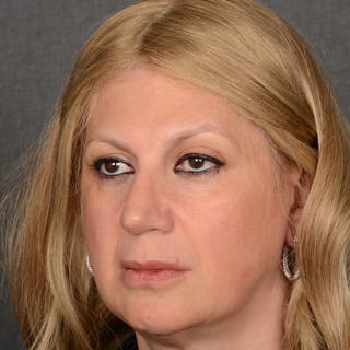 Corrective / Revision Rhinoplasty Before & After Gallery - Patient 317756 - Image 4