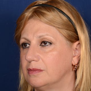 Corrective / Revision Rhinoplasty Before & After Gallery - Patient 317756 - Image 4
