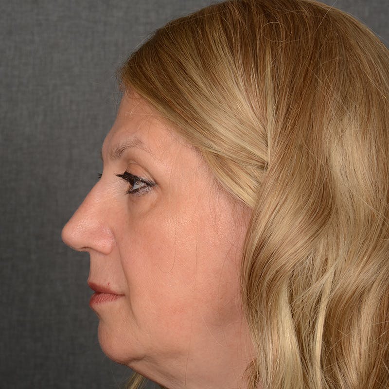 Corrective / Revision Rhinoplasty Before & After Gallery - Patient 317756 - Image 5