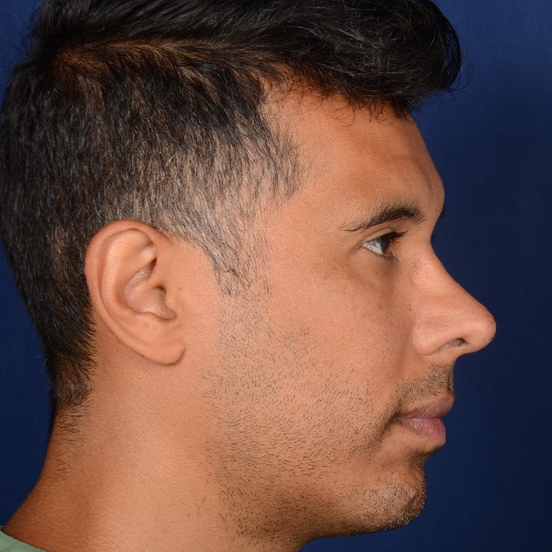 Corrective / Revision Rhinoplasty Before & After Gallery - Patient 286546 - Image 5