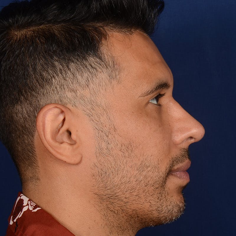 Corrective / Revision Rhinoplasty Before & After Gallery - Patient 286546 - Image 6