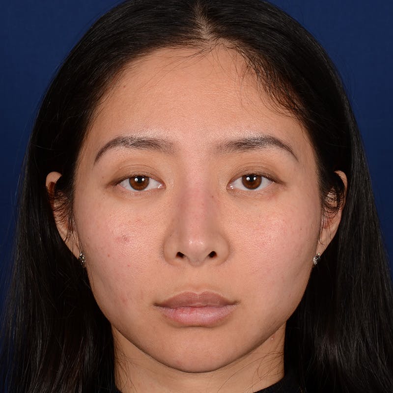 Corrective / Revision Rhinoplasty Before & After Gallery - Patient 187002 - Image 1
