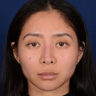 Corrective / Revision Rhinoplasty Before & After Gallery - Patient 187002 - Image 2