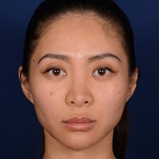 Corrective / Revision Rhinoplasty Before & After Gallery - Patient 187002 - Image 2