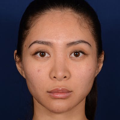 Corrective / Revision Rhinoplasty Before & After Gallery - Patient 187002 - Image 2