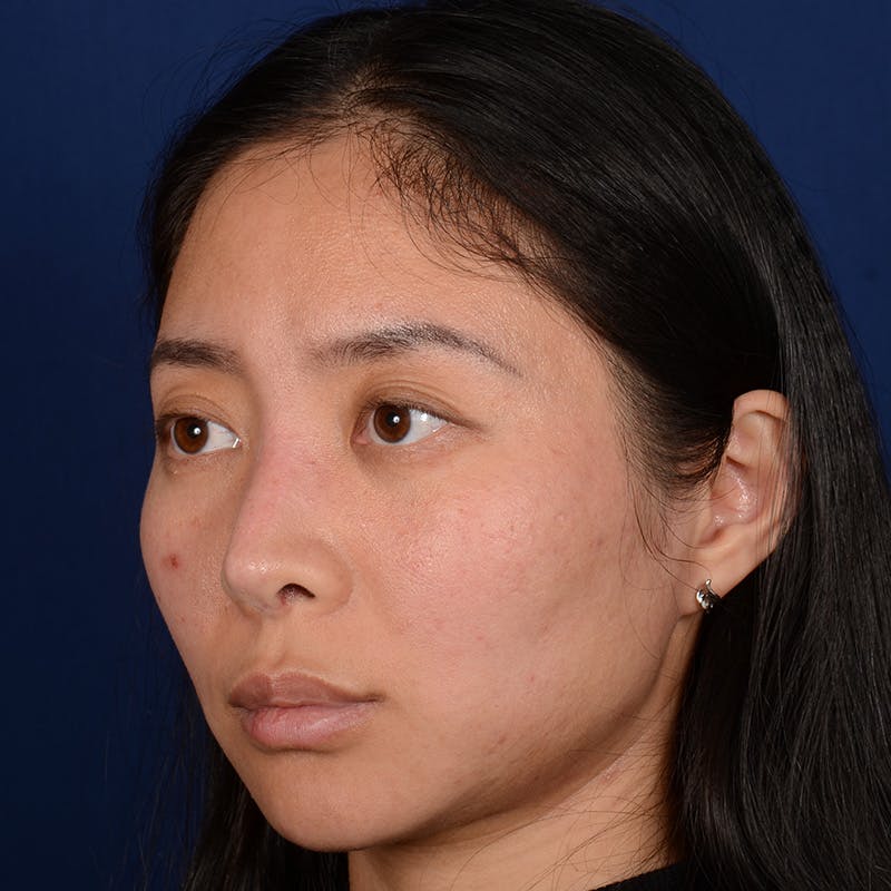 Corrective / Revision Rhinoplasty Before & After Gallery - Patient 187002 - Image 3