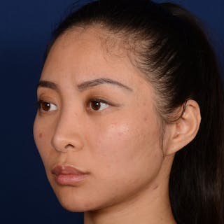 Corrective / Revision Rhinoplasty Before & After Gallery - Patient 187002 - Image 4