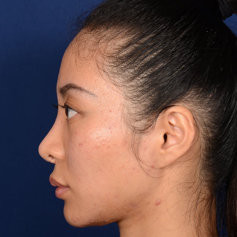 Corrective / Revision Rhinoplasty Before & After Gallery - Patient 187002 - Image 6