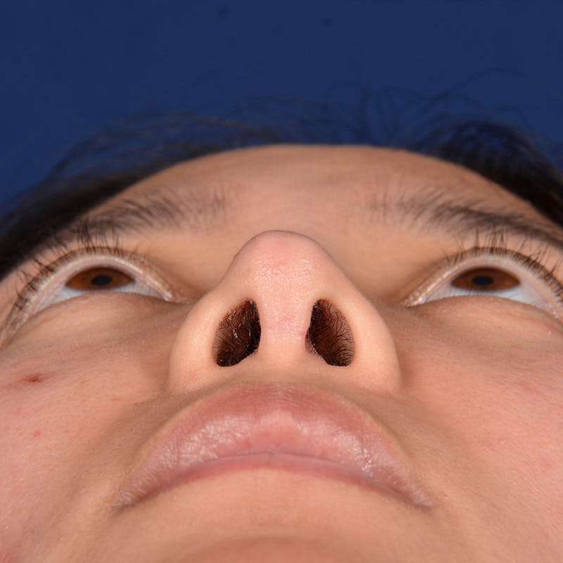 Corrective / Revision Rhinoplasty Before & After Gallery - Patient 187002 - Image 7
