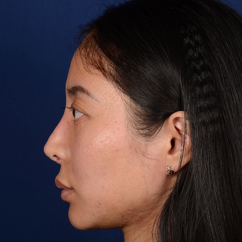 Corrective / Revision Rhinoplasty Before & After Gallery - Patient 187002 - Image 5