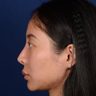 Corrective / Revision Rhinoplasty Before & After Gallery - Patient 187002 - Image 6