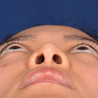 Corrective / Revision Rhinoplasty Before & After Gallery - Patient 187002 - Image 8