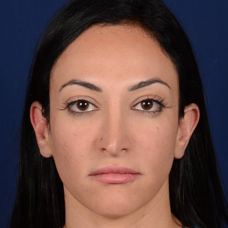 Corrective / Revision Rhinoplasty Before & After Gallery - Patient 529761 - Image 1