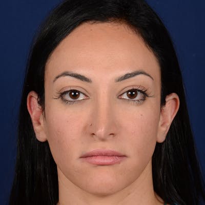 Corrective / Revision Rhinoplasty Before & After Gallery - Patient 529761 - Image 1
