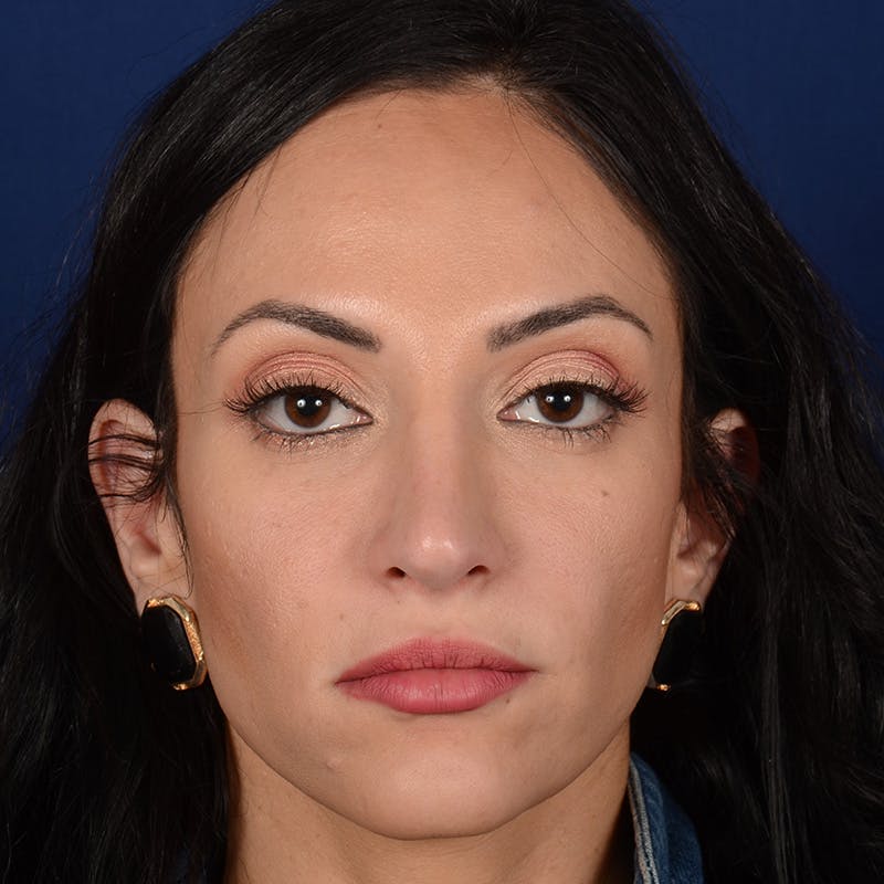 Corrective / Revision Rhinoplasty Before & After Gallery - Patient 529761 - Image 2