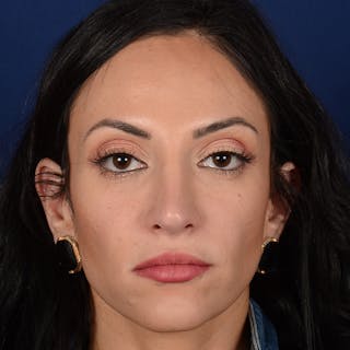 Corrective / Revision Rhinoplasty Before & After Gallery - Patient 529761 - Image 2