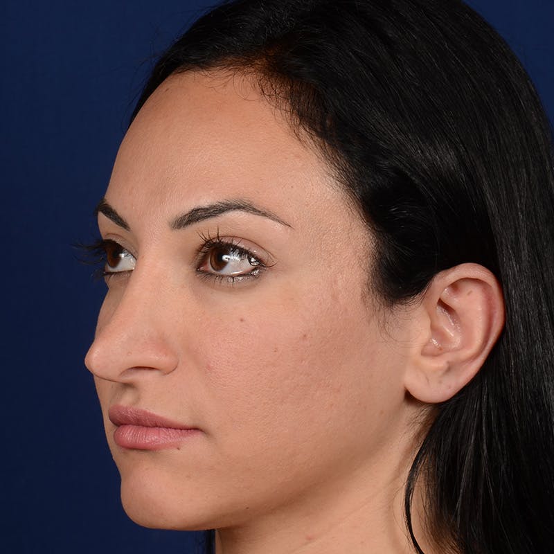 Corrective / Revision Rhinoplasty Before & After Gallery - Patient 529761 - Image 3