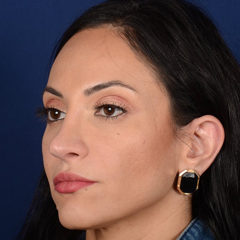 Corrective / Revision Rhinoplasty Before & After Gallery - Patient 529761 - Image 4