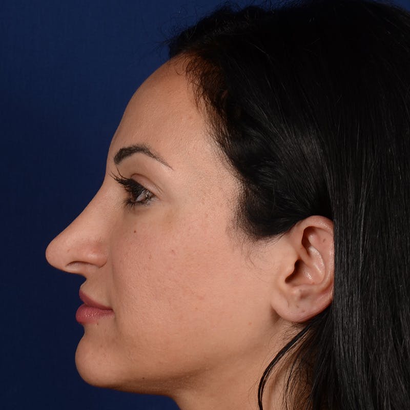 Corrective / Revision Rhinoplasty Before & After Gallery - Patient 529761 - Image 5