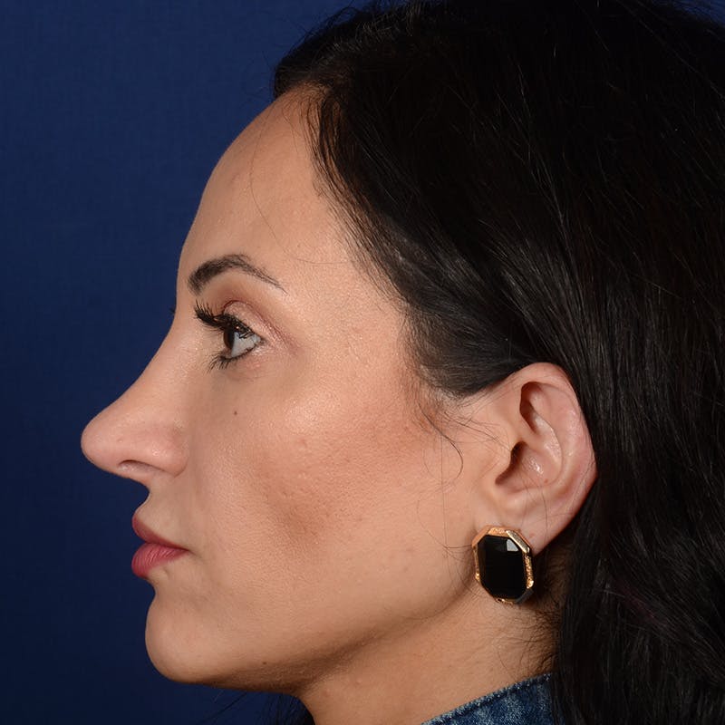 Corrective / Revision Rhinoplasty Before & After Gallery - Patient 529761 - Image 6