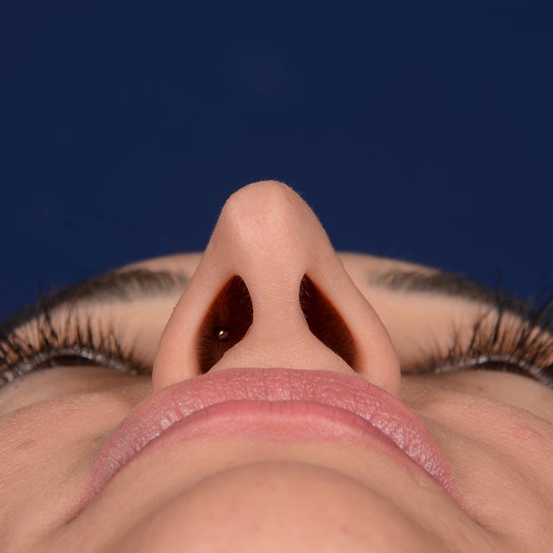 Corrective / Revision Rhinoplasty Before & After Gallery - Patient 529761 - Image 7