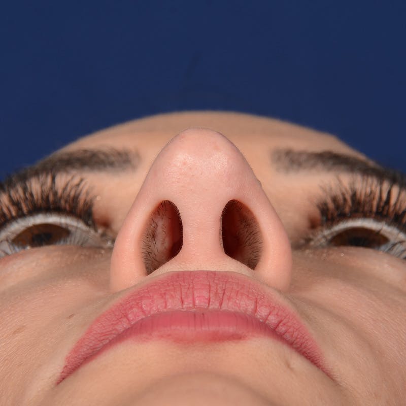 Corrective / Revision Rhinoplasty Before & After Gallery - Patient 529761 - Image 8