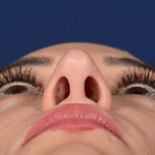 Corrective / Revision Rhinoplasty Before & After Gallery - Patient 529761 - Image 8