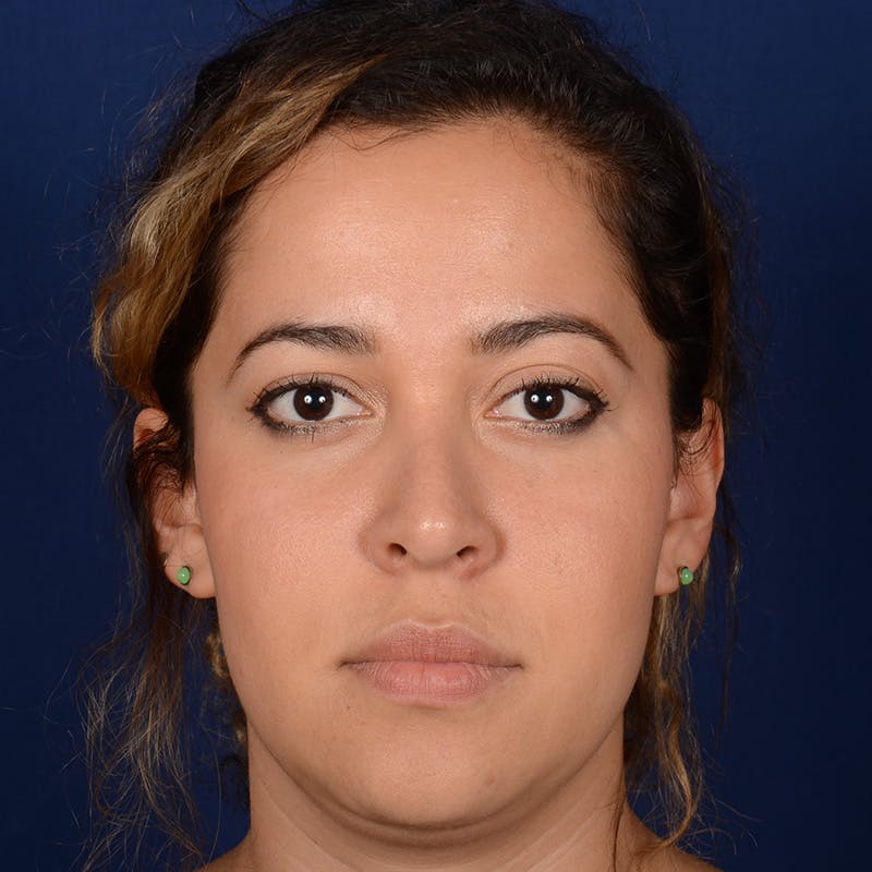 Corrective / Revision Rhinoplasty Before & After Gallery - Patient 846130 - Image 1
