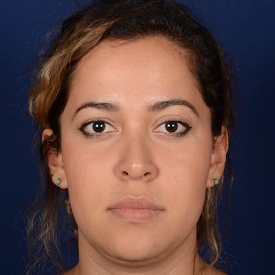 Corrective / Revision Rhinoplasty Before & After Gallery - Patient 846130 - Image 1