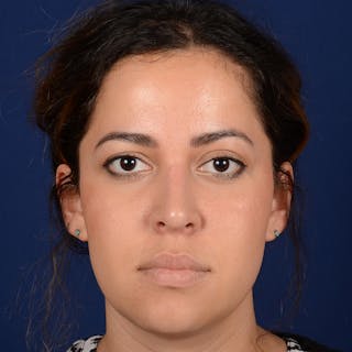 Corrective / Revision Rhinoplasty Before & After Gallery - Patient 846130 - Image 2