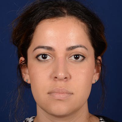 Corrective / Revision Rhinoplasty Before & After Gallery - Patient 846130 - Image 2