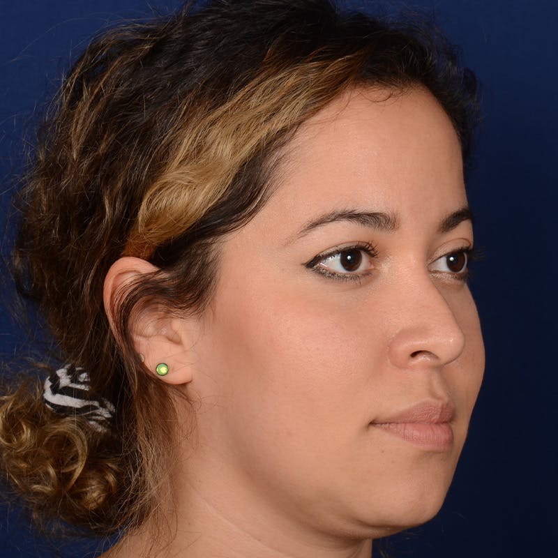 Corrective / Revision Rhinoplasty Before & After Gallery - Patient 846130 - Image 3