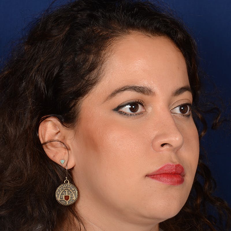 Corrective / Revision Rhinoplasty Before & After Gallery - Patient 846130 - Image 4