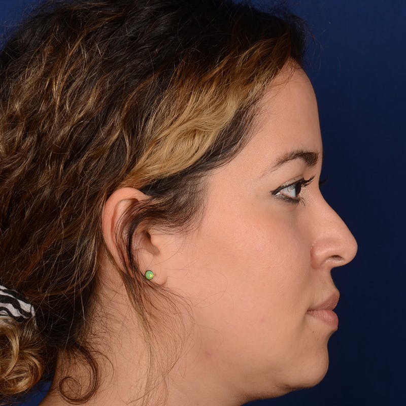 Corrective / Revision Rhinoplasty Before & After Gallery - Patient 846130 - Image 5