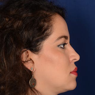 Corrective / Revision Rhinoplasty Before & After Gallery - Patient 846130 - Image 6