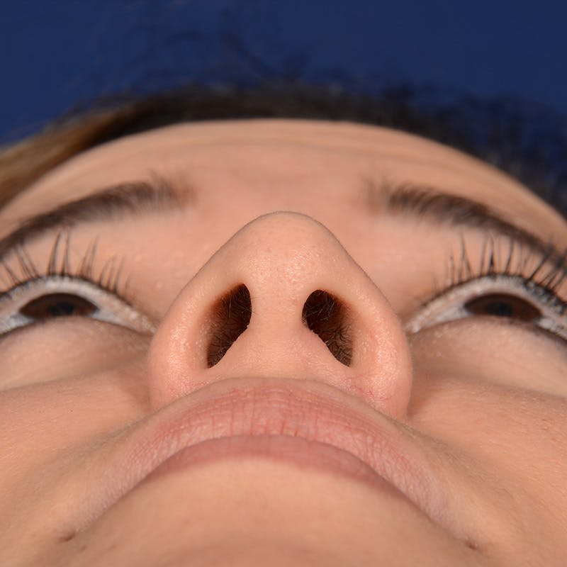 Corrective / Revision Rhinoplasty Before & After Gallery - Patient 846130 - Image 7