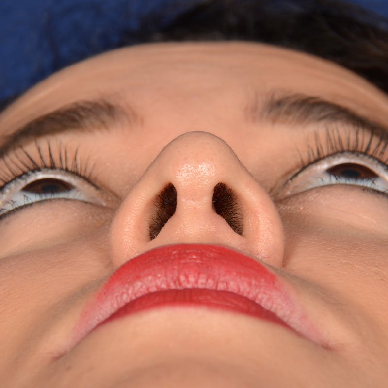Corrective / Revision Rhinoplasty Before & After Gallery - Patient 846130 - Image 8